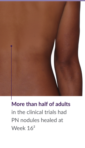 31-year-old female patient with reduced raised bumps and nodules after NEMLUVIO® (nemolizumab-ilto) treatment for prurigo nodularis (PN).