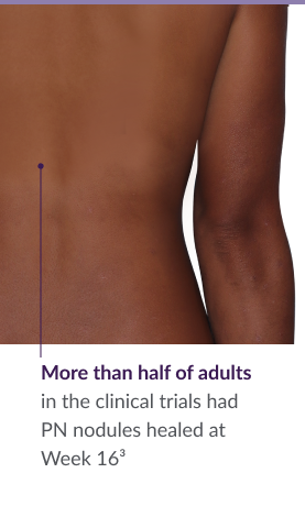 31-year-old female patient with reduced raised bumps and nodules after NEMLUVIO® (nemolizumab-ilto) treatment for prurigo nodularis (PN).