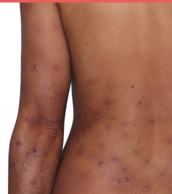 31-year-old female patient with raised bumps and nodules before NEMLUVIO® (nemolizumab-ilto) treatment for prurigo nodularis (PN).