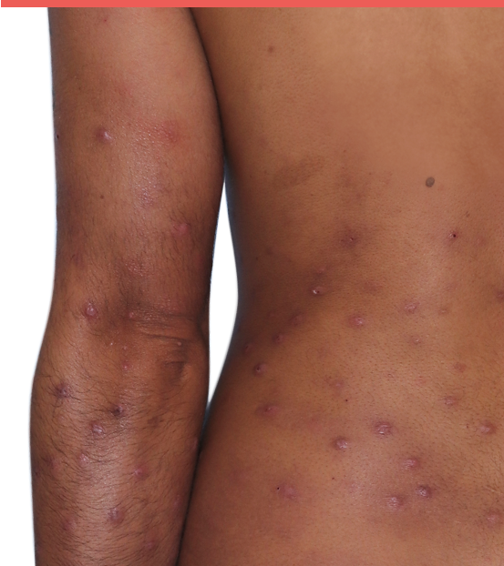 31-year-old female patient with raised bumps and nodules before NEMLUVIO® (nemolizumab-ilto) treatment for prurigo nodularis (PN).