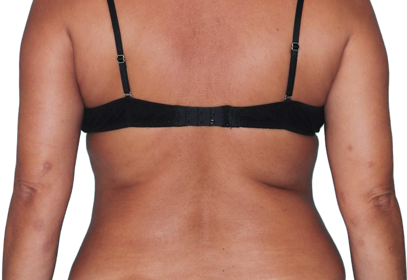 43-year-old female patient with reduced raised bumps and nodules after NEMLUVIO® (nemolizumab-ilto) treatment for prurigo nodularis (PN).