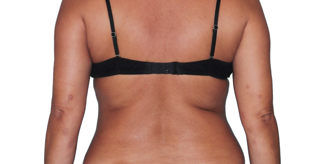 43-year-old female patient with reduced raised bumps and nodules after NEMLUVIO® (nemolizumab-ilto) treatment for prurigo nodularis (PN).