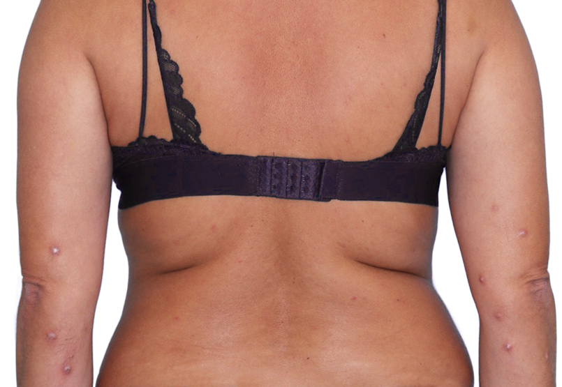 43-year-old female patient with raised bumps and nodules before NEMLUVIO® (nemolizumab-ilto) treatment for prurigo nodularis (PN).