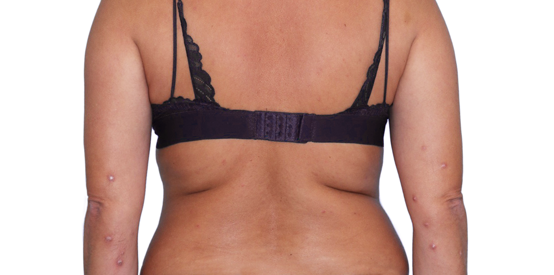 43-year-old female patient with raised bumps and nodules before NEMLUVIO® (nemolizumab-ilto) treatment for prurigo nodularis (PN).