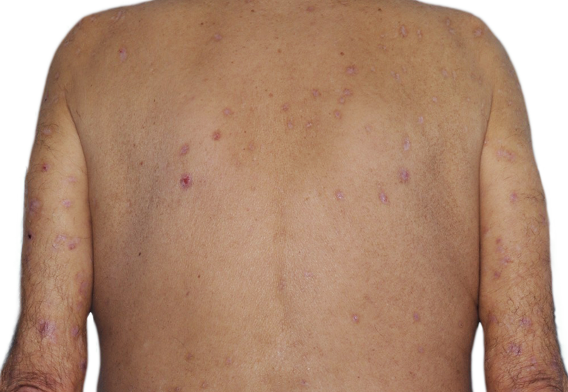 73-year-old male patient with reduced raised bumps and nodules after NEMLUVIO® (nemolizumab-ilto) treatment for prurigo nodularis (PN).