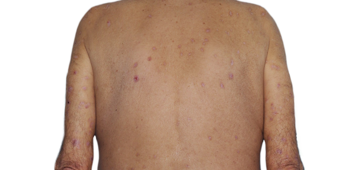 73-year-old male patient with reduced raised bumps and nodules after NEMLUVIO® (nemolizumab-ilto) treatment for prurigo nodularis (PN).