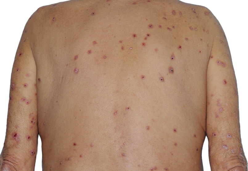 73-year-old male patient with raised bumps and nodules before NEMLUVIO® (nemolizumab-ilto) treatment for prurigo nodularis (PN).