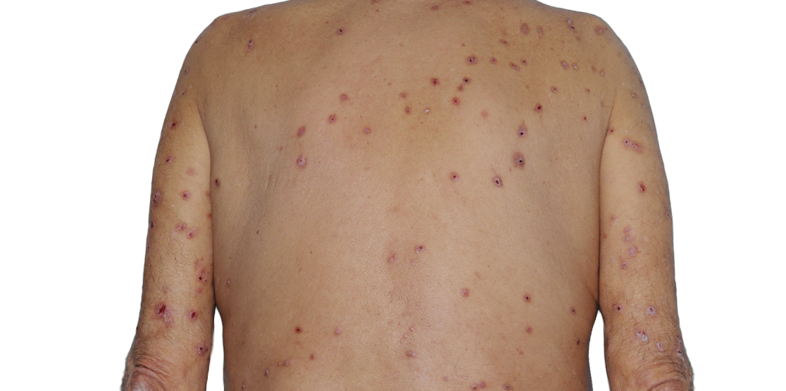 73-year-old male patient with raised bumps and nodules before NEMLUVIO® (nemolizumab-ilto) treatment for prurigo nodularis (PN).